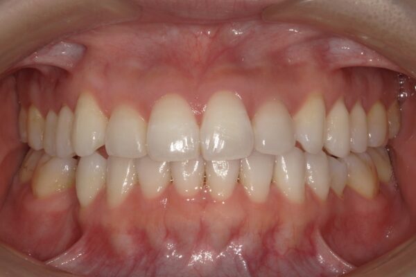 インビザライン治療後