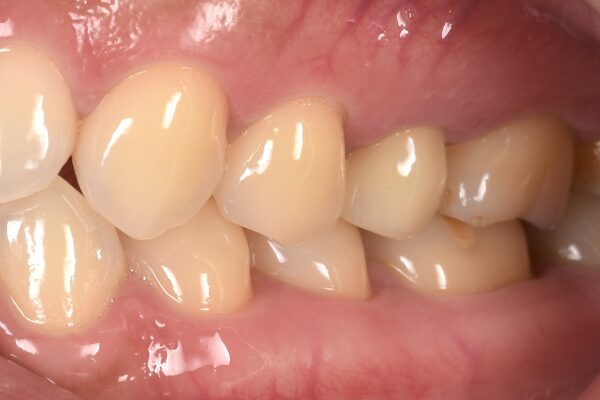 e-maxCr（左上５番）治療後