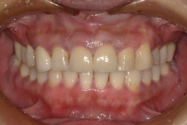 ガムピーリング治療後