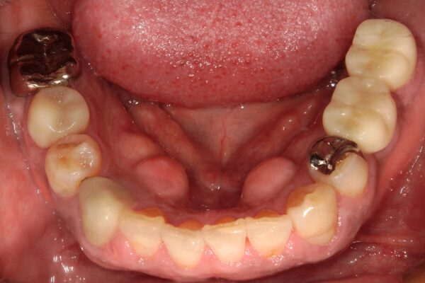 インプラント治療後