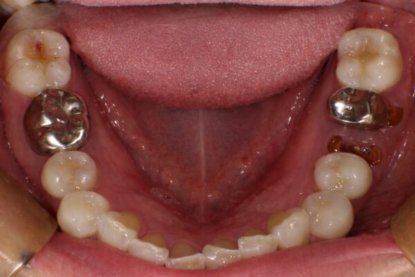 インプラント治療前