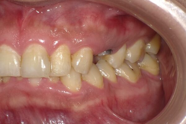 インプラント治療前