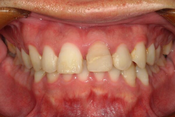 インビザライン治療前