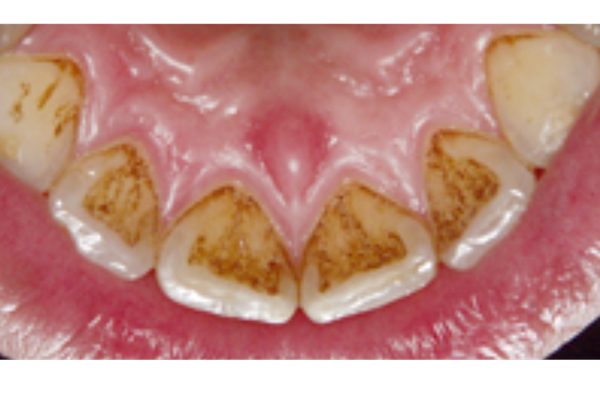 クリーニング前の歯石や汚れが付着した口腔内写真