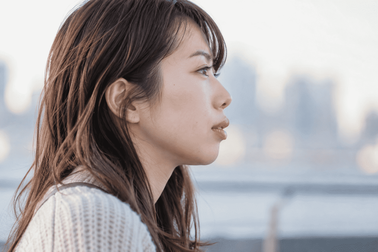 出っ歯（上顎前突）の状態を示すイメージ